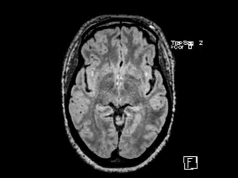 White matter disease associated with migraine headaches